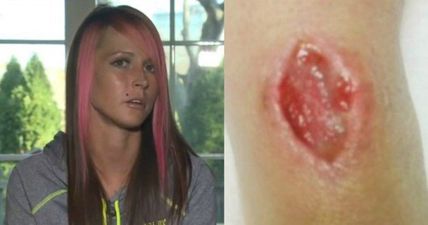 Woman Contracted Flesh Eating Bacteria From Wearing a Hair Tie on Her Wrist