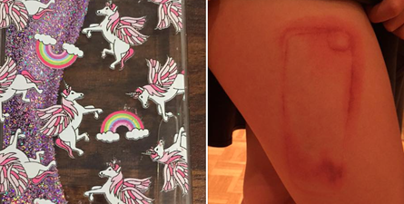 Girl Left With Severe Burn After iPhone Case Leaked Acid Onto Her Leg