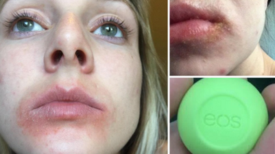 EOS is Reportedly Being Sued for Causing Severe Blisters