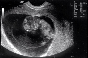 PICS: Dublin Girl Leaves Facebook Logged In – Dicey’s Pregnancy Frape Quickly Goes Viral