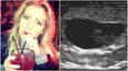22-Year-Old Woman Dies After Tumour Mistaken for Pregnancy  