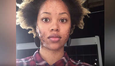 WATCH: Here’s What Happens When People With Clear Skin Live With Acne For a Day