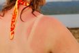 Random Fact of The Day: This Every Day Household Item Is an Effective Treatment for Sunburn