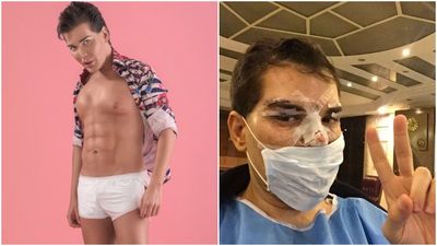 “Human Ken Doll” suffering from a rotting nose