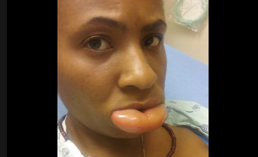 Woman shares Facebook post after suffering alarming allergic reaction to lipstick