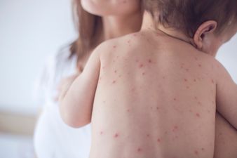 The HSE has issued a warning following an outbreak of measles in different parts of Ireland