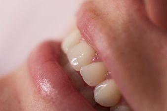 How this woman reacted to teeth whitening has put us right off the idea