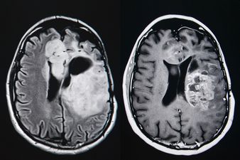 I have a tumour in my brain, and I’m happy about it