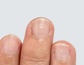 Here are the reasons why you may have white marks on your nails