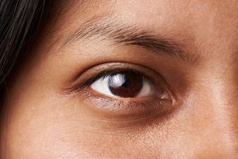 Dark circles around your eyes can indicate a common health complaint