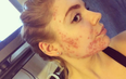 This woman cured her acute acne by making three lifestyle changes