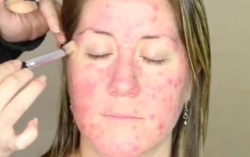 This incredible acne makeup tutorial is causing an awful lot of controversy