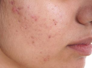 People are swearing by this pharmacy-stocked acne treatment