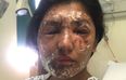 Acid attack survivor shares first incredible pictures of her recovery