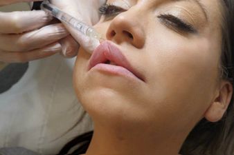 I got my lips enhanced with filler for the first time and here’s how I got on