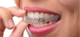 Why you should be wearing your retainer for the rest of your life