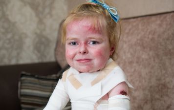 5-year-old girl’s skin disease leaves her in full body bandages every day