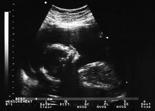 A Galway mum says her baby died… because she wasn’t given a scan