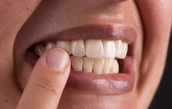 This woman bought €32 stick-on veneers and the result was hysterical