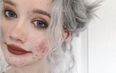 Girl’s before-and-after acne photos encourage others to not be ashamed