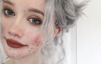 Girl’s before-and-after acne photos encourage others to not be ashamed