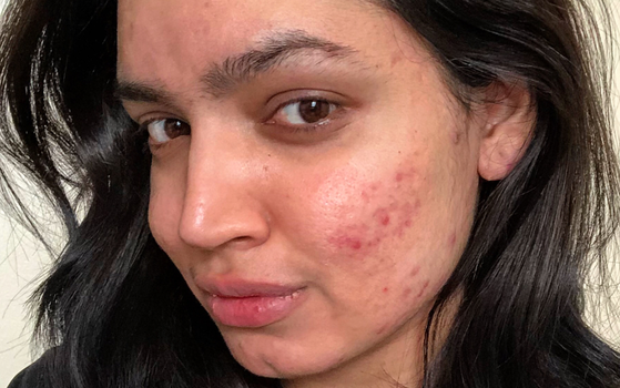 Blogger claims she was dropped from major beauty campaign over her 'skin issues'