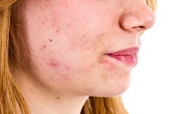 We are intrigued! The €5 product that’s said to work wonders for acne