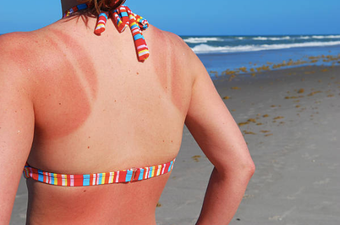 What to do immediately if you get a sunburn (and what you should absolutely avoid)