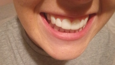 I wore clip-in veneers for a day – here’s what I really thought