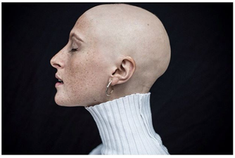 Stunning Irish model with alopecia covers magazine totally hair-free