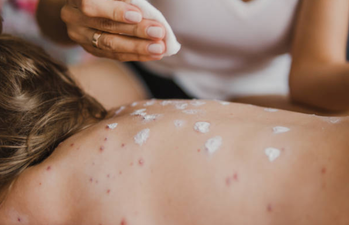 Five cases of the measles have just been confirmed in Dublin