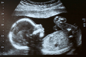 A baby in South America was born with her own twin growing inside of her