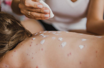 Update: Measles outbreak has been confirmed in Dublin City