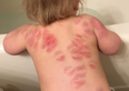 Mother finds at least 25 bite marks on daughter’s body after picking her up from nursery