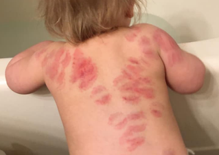 Mother finds at least 25 bite marks on daughter’s body after picking her up from nursery