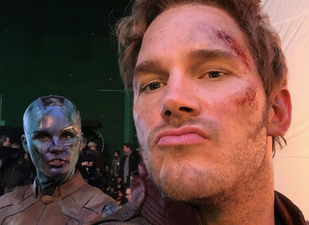 Chris Pratt’s sunburn will make you never want to go outside again