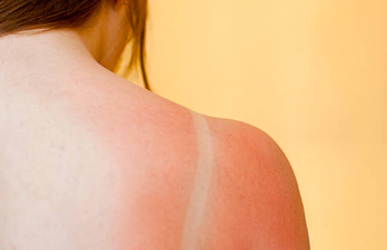 Experts warn that skin cancer will treble over the next 20 years