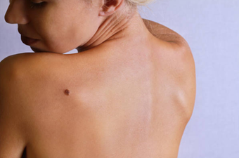 Boots now offering crucial mole scanning service in 17 stores nationwide