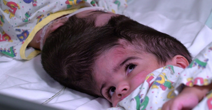 Conjoined twins successfully separated following 50 hour surgery in London