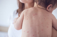 Four European countries lose measles-free status, says WHO