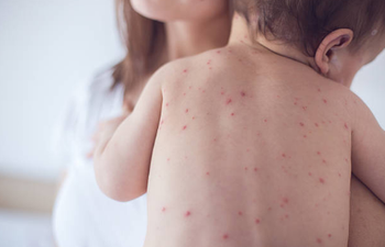 Four European countries lose measles-free status, says WHO