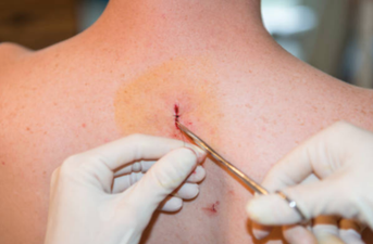 “I never thought it would be cancer”: Stage 4 melanoma patient recalls receiving her diagnosis