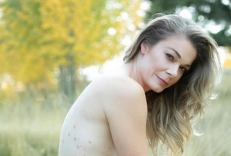 “80% of my body was covered:” LeAnn Rimes on life-long Psoriasis battle