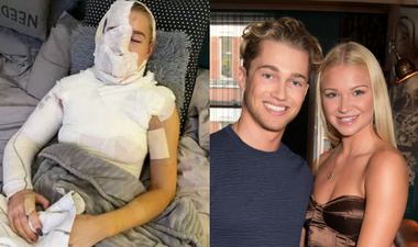 Abbie Quinnen, AJ Pritchard’s partner, pictured since suffering third degree burns