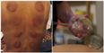 I tried the cupping therapy popular with celebrities  – and here is what happened