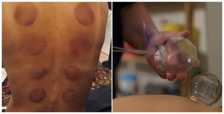 I tried the cupping therapy popular with celebrities  – and here is what happened