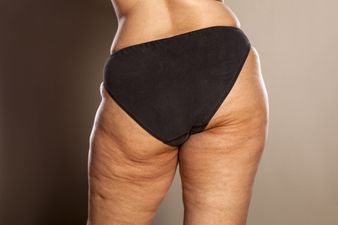 Cellulite is completely normal – but why do we get it?