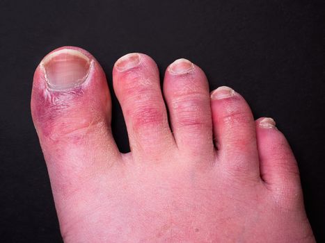 A foot with red, swollen toes.