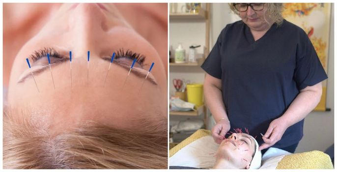 I tried cosmetic acupuncture and here is what happened