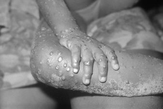 Only a matter of time before monkeypox spreads to Ireland, says expert